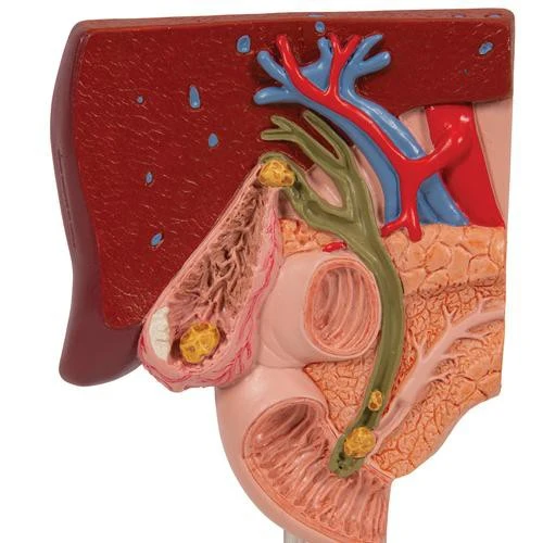 Modelo de cálculo biliar - 3B Smart Anatomy 3B Scientific
