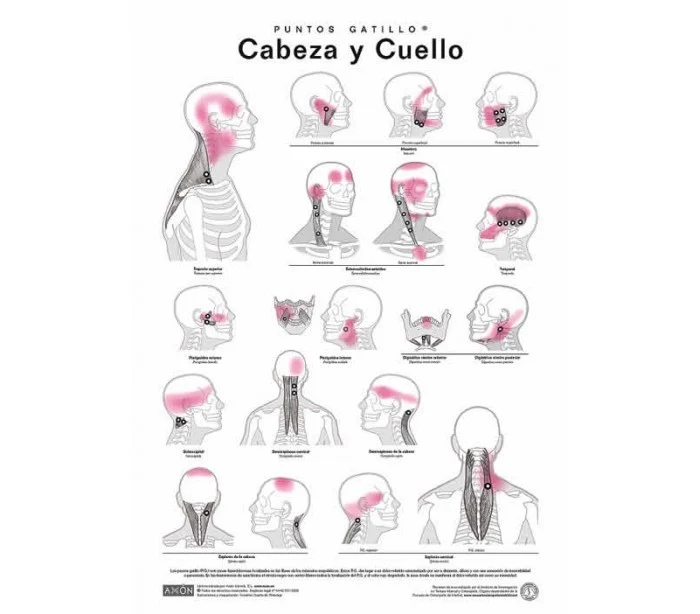 Láminas de Puntos Gatillo Axon