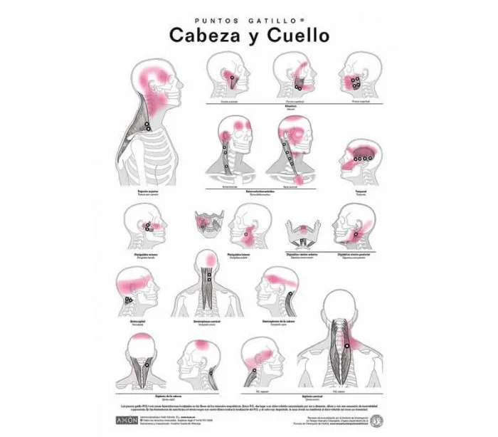 Láminas de Puntos Gatillo Axon