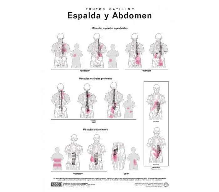 Láminas de Puntos Gatillo Axon