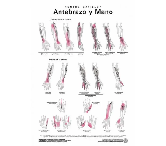 Láminas de Puntos Gatillo Axon